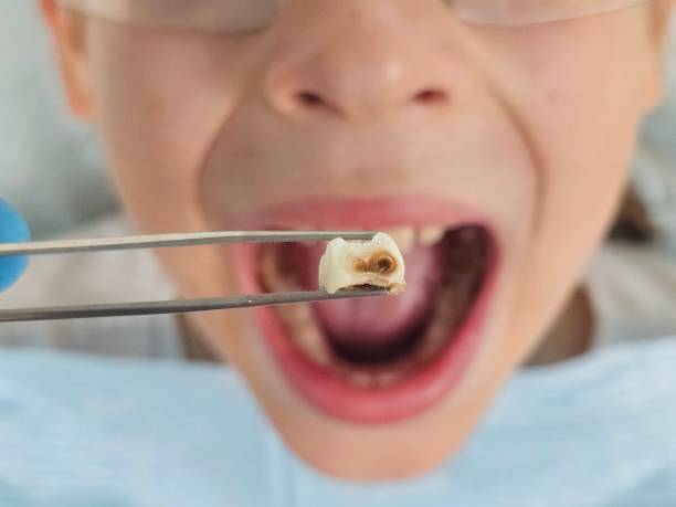Best Urgent Care for Lost Fillings or Crowns in Meyers, CA