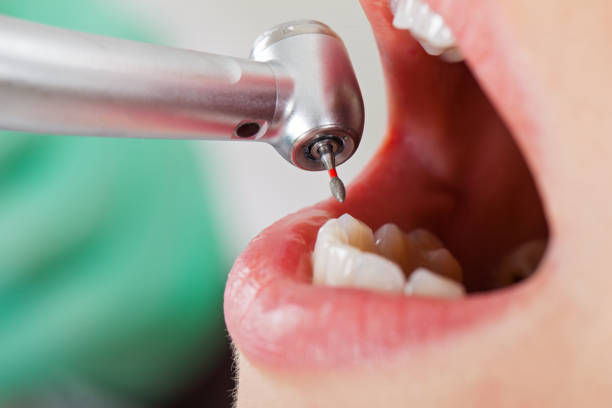 Best Emergency Treatment for Dental Infections or Abscesses in Meyers, CA